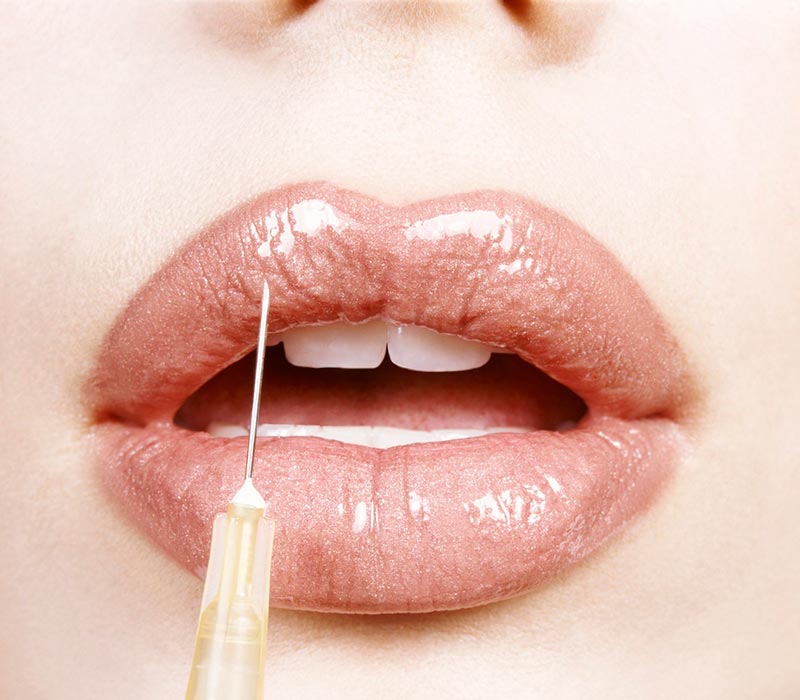 Dermal Filler